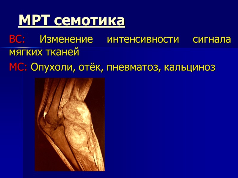 МРТ семотика ВС: Изменение интенсивности сигнала мягких тканей МС: Опухоли, отёк, пневматоз, кальциноз